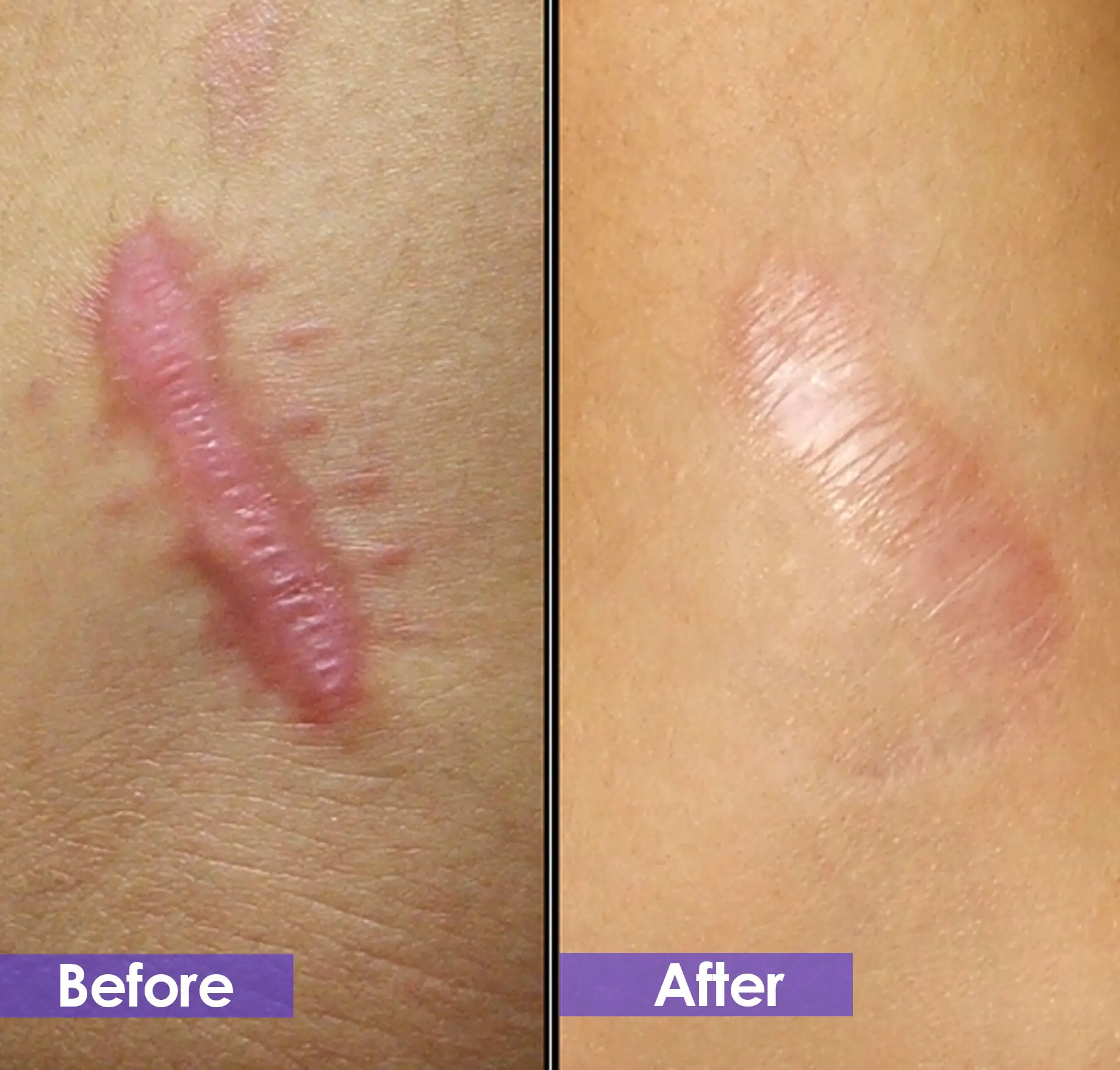 scar removal before and after